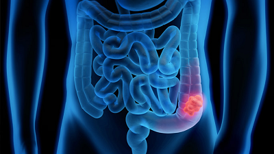 Colorectal Cancer: Understanding The Symptoms, Diagnosis, And Treatment ...